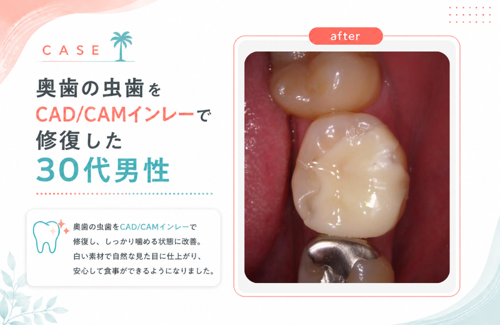 奥歯の虫歯をCAD/CAMインレーで修復した30代男性