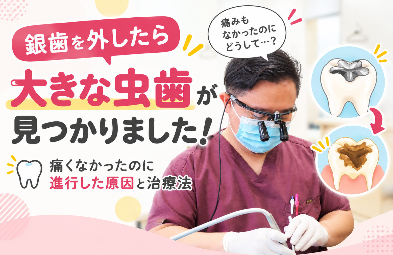銀歯を外したら大きな虫歯が！痛くなかったのに進行した原因と治療法